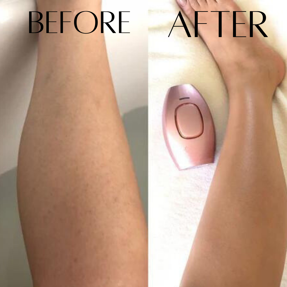 Trendy-Laser Hair Removal